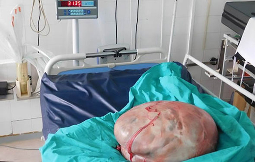 tumour 